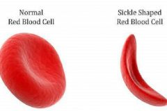 sickle-cell-anemia Cameroonian children with sickle-cell disease face death