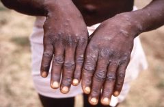 Biya regime says Amba fighters are preventing health workers from assisting Monkeypox patients