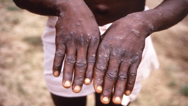Monkeypox alert issued in French Cameroun