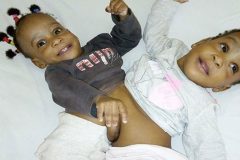 Cameroonian Conjoined twins successfully separated in France
