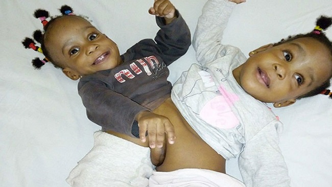 Cameroonian Conjoined twins successfully separated in France