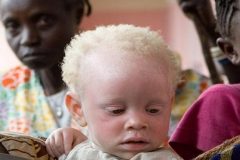 Cameroon’s albinos threatened by magic and superstition