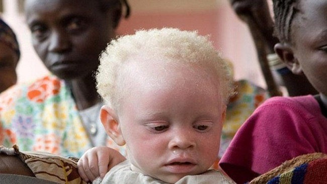 Cameroon’s albinos threatened by magic and superstition